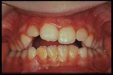 tsfing1teeth.jpg